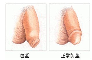 包皮手术,阜阳包皮手术费用