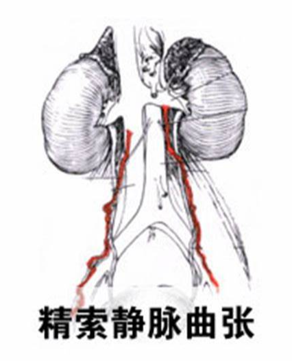 精索静脉曲张,精索静脉曲张原因,精索静脉曲张危害