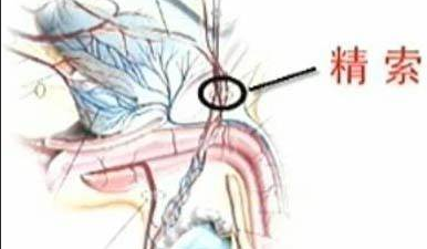 精索静脉曲张,精索静脉曲张原因,阜阳精索静脉曲张原因